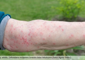 Zeltvēdera mūķenes izraisīts ādas iekaisums uz rokas